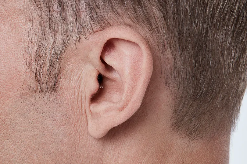 Invisible in the canal hearing aid shown worn in the ear